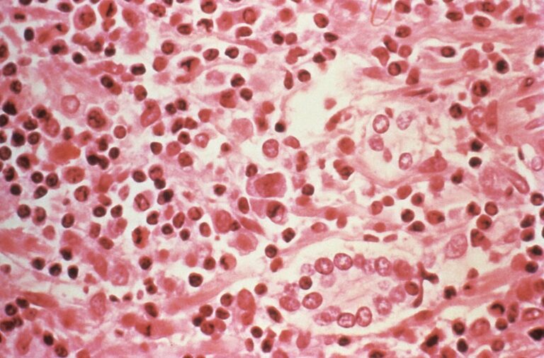 FDA одобрило первый антисмысловой препарат для лечения хронического гепатита B FDA одобрило первый антисмысловой препарат для лечения хронического гепатита B